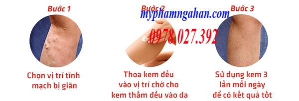 kem-varikosette-2 (1)