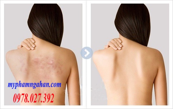 xa-phong-tri-mun-lung-va-viem-nang-long-nga-2 (1)